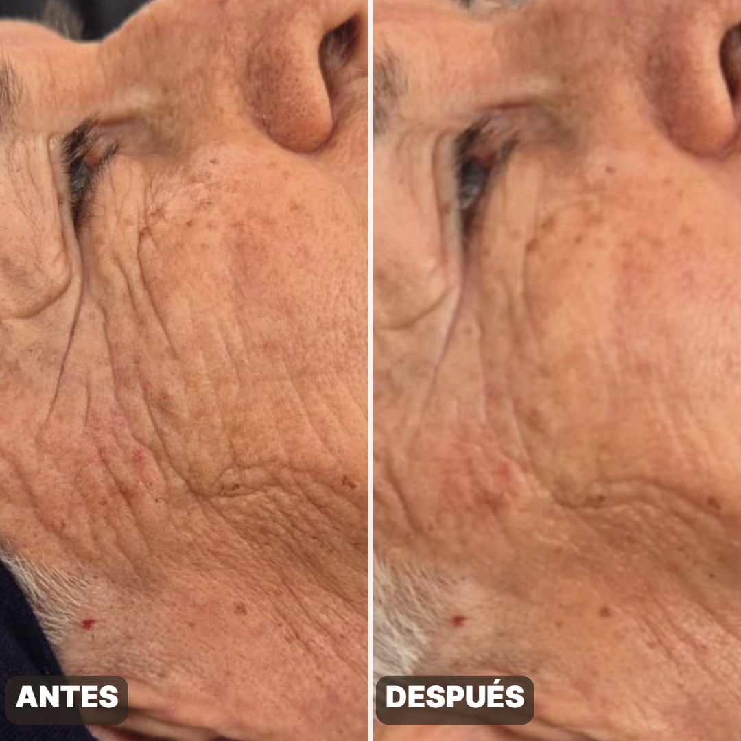 Antes y después — Rostro
